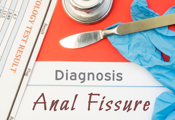 A Comprehensive Guide to Anal Fissure Prevention