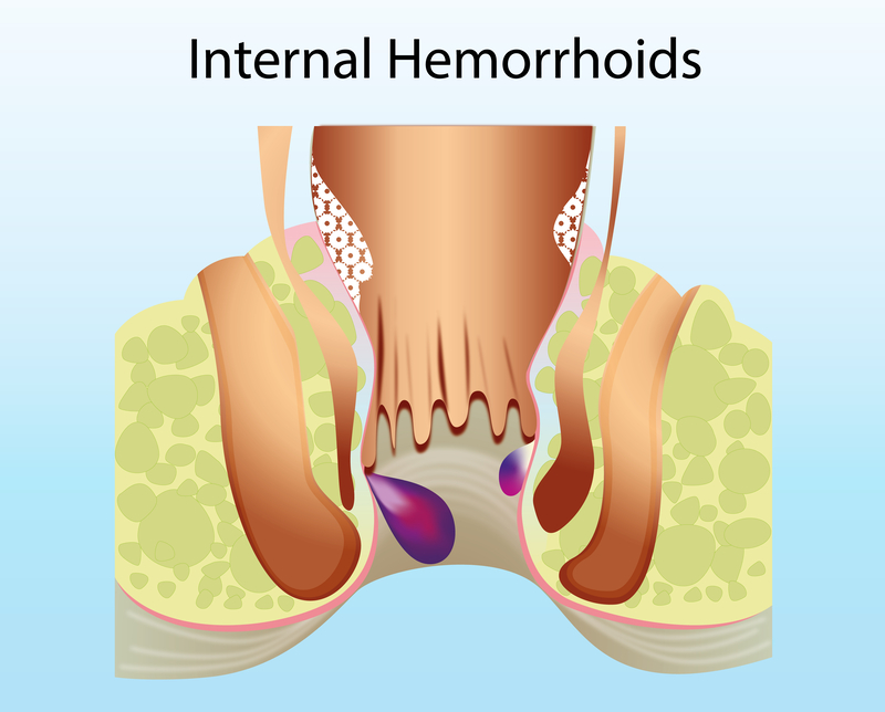 Internal Hemorrhoids - RS Surgical - Causes, Symptoms, Treatment