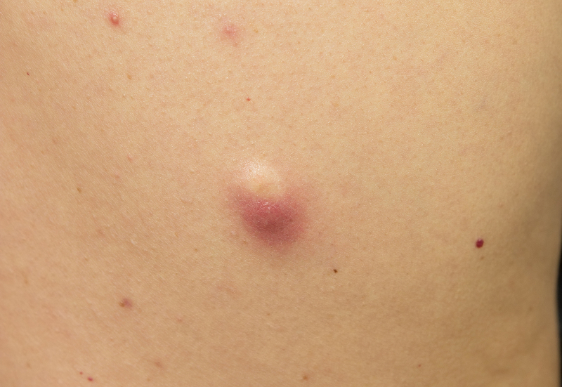 epidermoid cysts on back