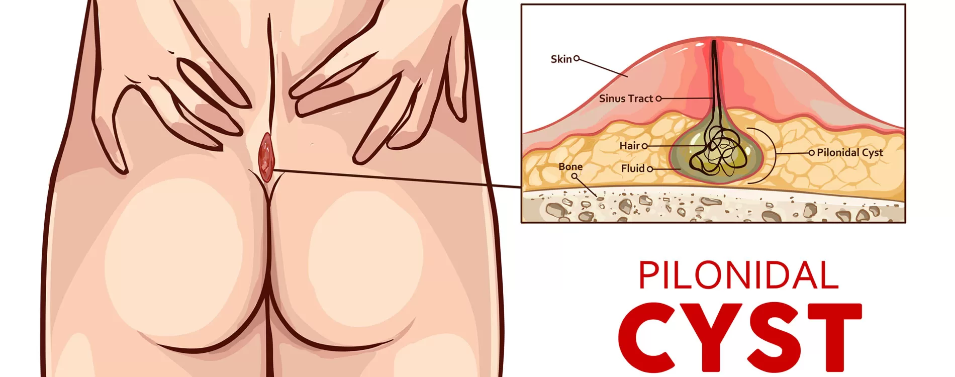 Pilonidal cyst